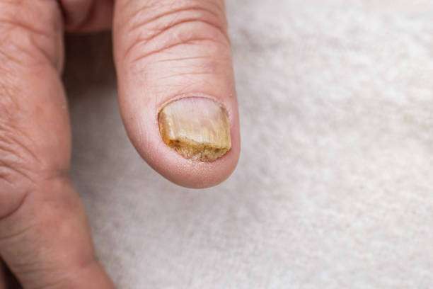 How to get rid of green nail fungus