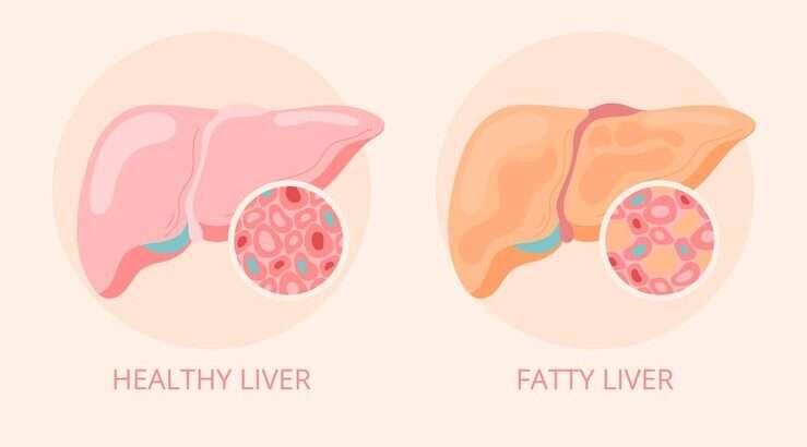 Life Expectancy with Fatty Liver Disease: What to Know