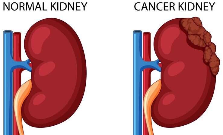 How Can We Prevent Kidney Disease